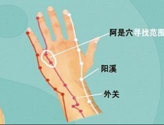 湿疹老是反反复复怎么治疗,湿疹反反复复的该怎么治疗