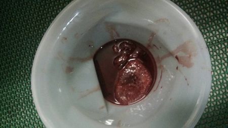 药流的副作用和风险,药流会引起大出血怎么办