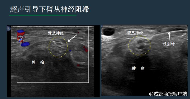 治疗病人的催眠方法,如何发挥自我催眠潜能治疗癌症