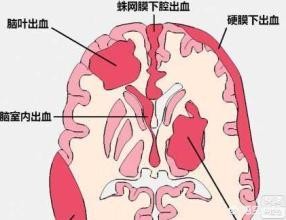 急性缺血性脑卒中血压管理,出血性脑卒中的急救