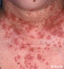 靶向治疗不良反应,靶向治疗也有很大的副作用吗