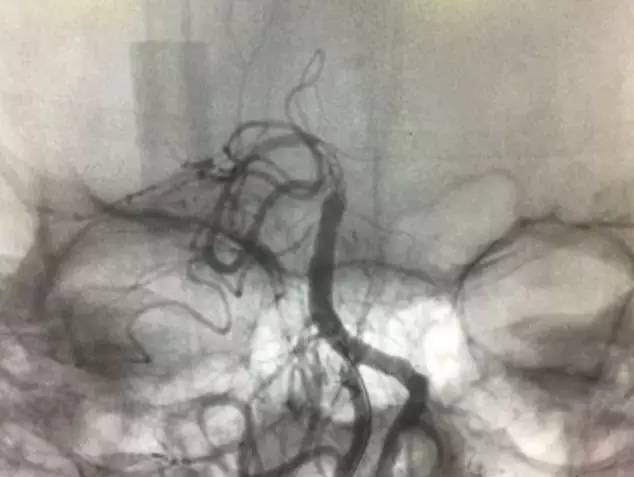 市人民医院取栓手术的全过程,病例分享视频素材