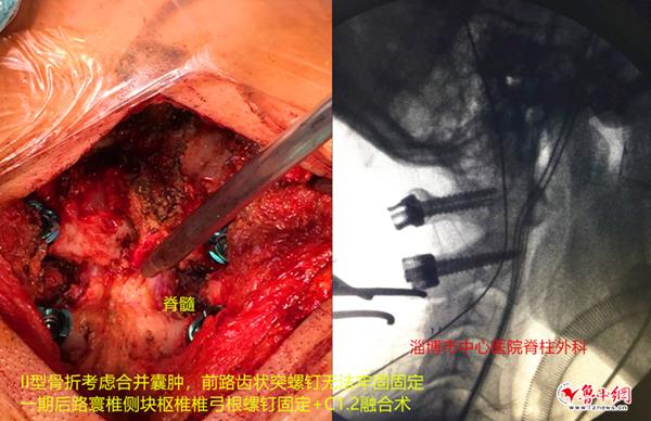 淄博市中心医院脊柱外科顺利完成高难度上颈椎手术
