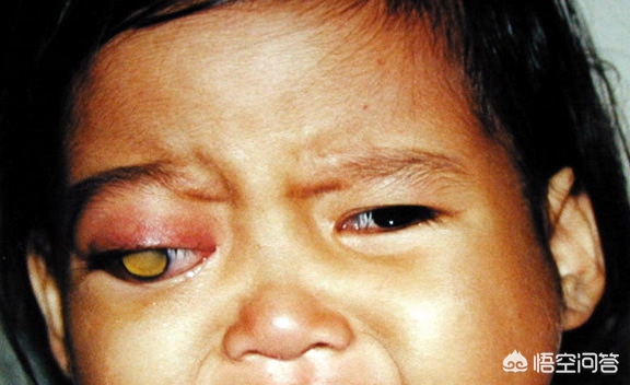 夺去王凤雅小朋友生命的视网膜母细胞瘤能治愈吗？