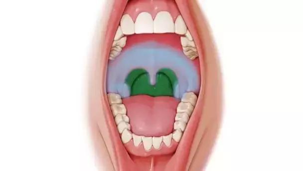手足口病疱疹性咽峡炎如何防治,疱疹性咽峡炎的防治