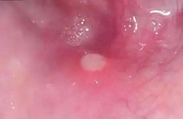 手足口病疱疹性咽峡炎如何防治,疱疹性咽峡炎的防治