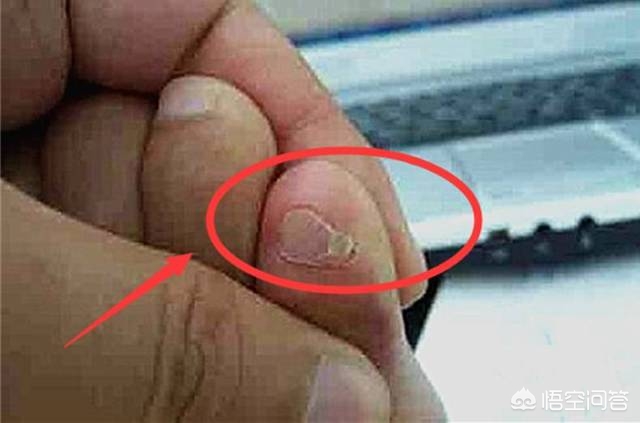 小脚趾分两瓣的人是哪个民族,小脚趾甲分两瓣是哪个民族的特征