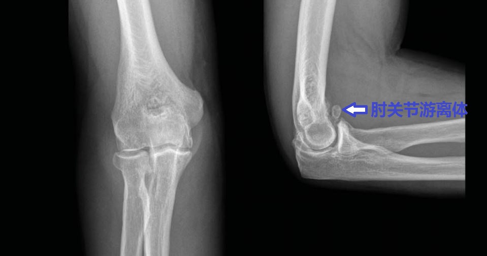 20年前肘关节伸不直,肘关节顶住墙怎么治疗