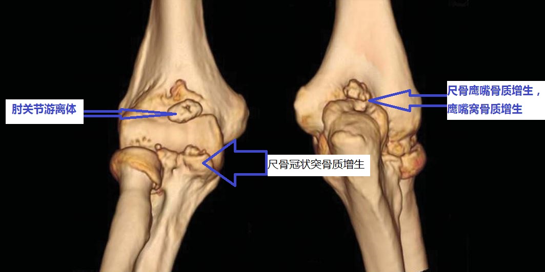 20年前肘关节伸不直,肘关节顶住墙怎么治疗