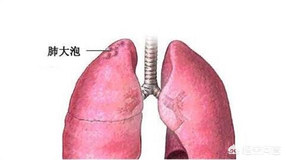 肺内常有气泡破裂的感觉并有疼痛感是怎么回事，可能是气胸前奏