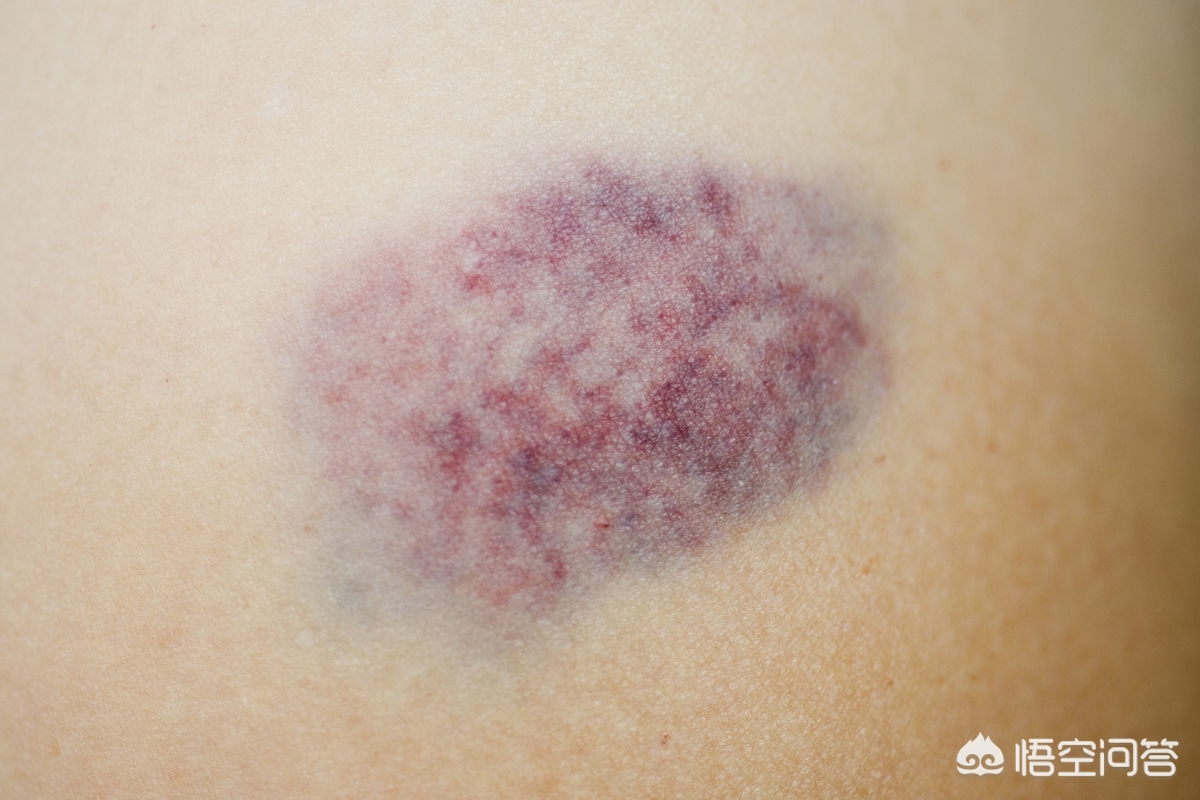 月经期为什么会有淤青,月经期褐红分泌物怎么回事