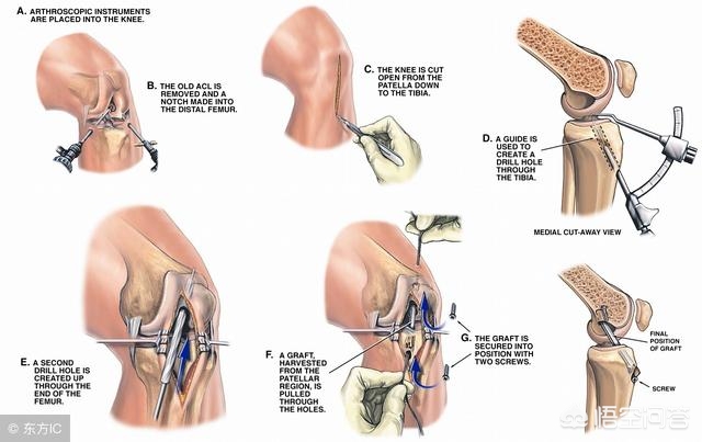 韧带跟筋有什么区别,韧带和骨头断哪个严重