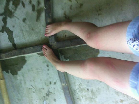 你被蚊子咬了吗是什么梗,四川墨蚊咬了以后怎么治疗