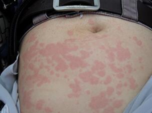 麻疹好了又得了荨麻疹,麻疹需要去医院吗