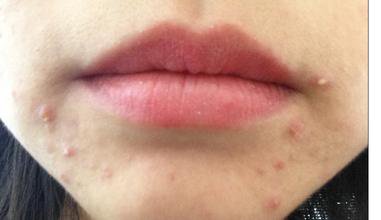 有效预防痤疮的方法,疮疡的最佳治疗方法