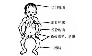 宝宝有严重佝偻病怎么办,宝宝得了佝偻病怎么治