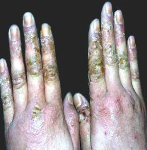 湿疹老是反反复复怎么治疗,湿疹反反复复的该怎么治疗