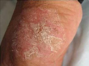 湿疹老是反反复复怎么治疗,湿疹反反复复的该怎么治疗