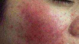 激素皮炎戒断期痒怎么办,激素依赖性皮炎脖子很痒