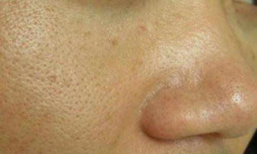 黑头怎么去掉呢，应该很多朋友对此比较感兴趣哦