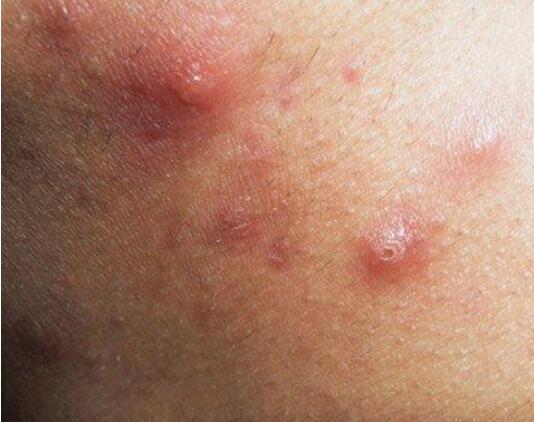 疮疤怎样彻底消除,很严重的干疮用什么药最好