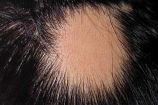 中医治疗脱发摘要,中医治疗脱发讲课