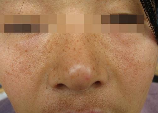 男性斑点怎么内调,男性褐斑怎么治