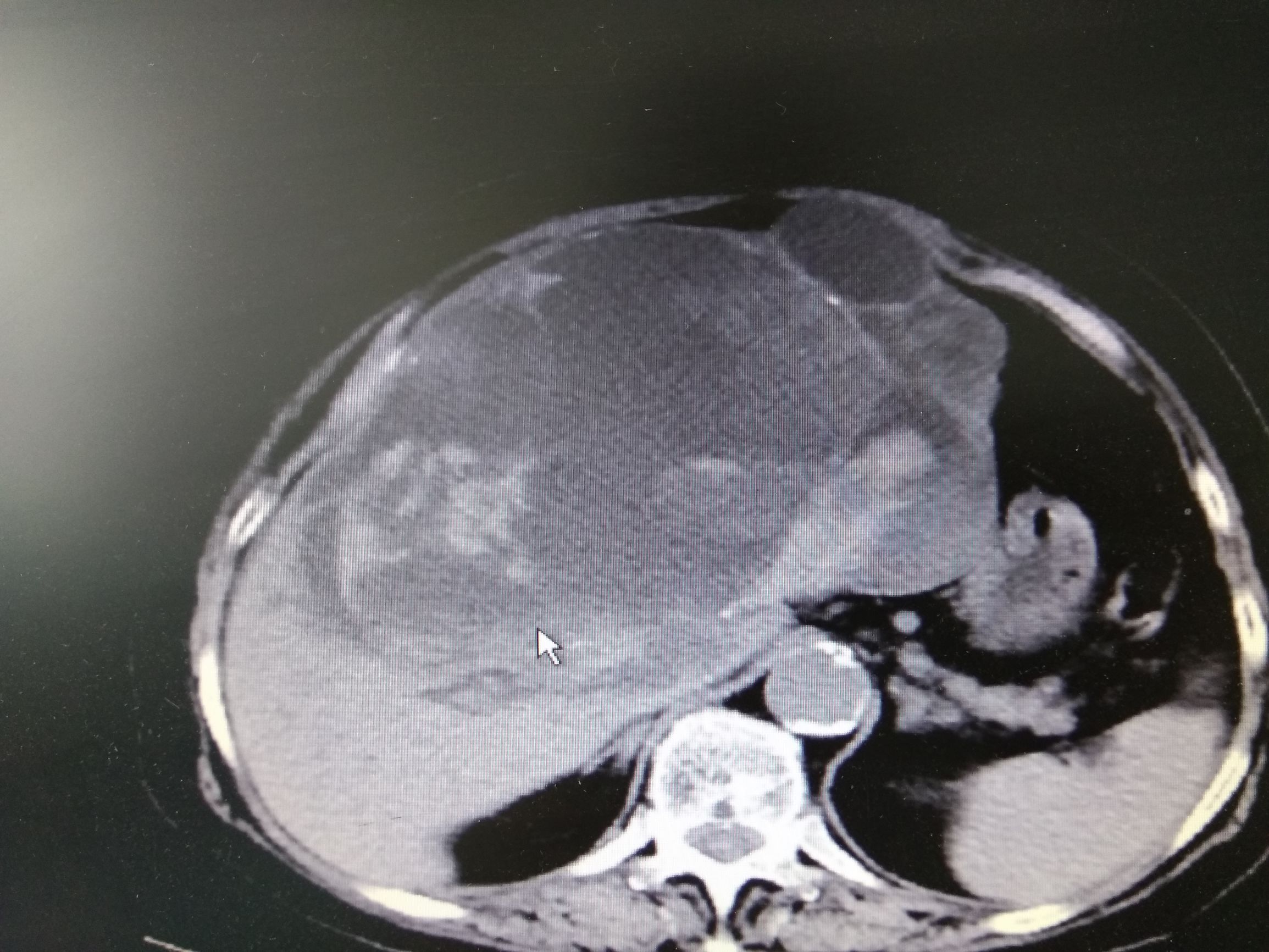 她因为诊断肝囊肿反复穿刺抽液，最后却被证实是癌。