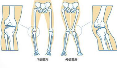 宝宝有严重佝偻病怎么办,宝宝得了佝偻病怎么治