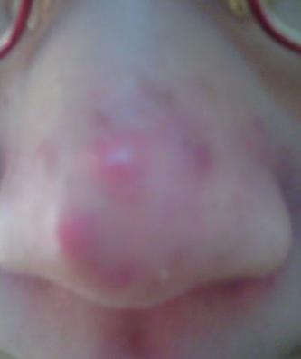 鼻子长痘痘怎么调理小妙招,鼻子长痘痘是上火吗