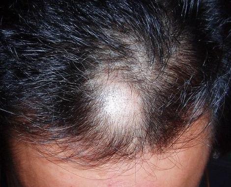 中医治疗脱发摘要,中医治疗脱发讲课