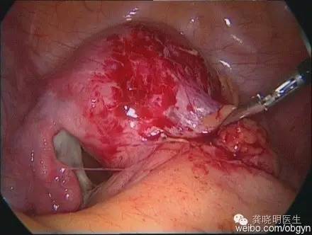 子宫肌瘤剔除手术一般要多久时间,子宫肌瘤剔除术做的不干净怎么办