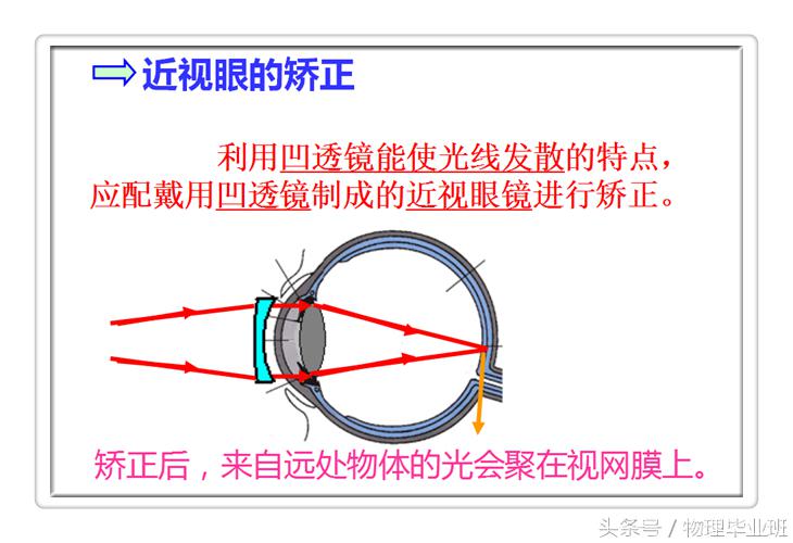 近视眼和远视眼的物理图片大全,物理近视眼远视眼的成因及矫正图