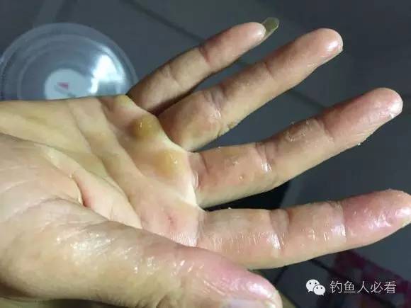 手对饵料过敏有什么办法解决吗,饵料过敏烧手怎么办
