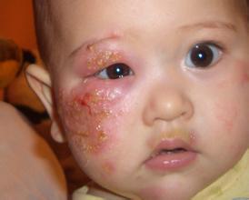 新生儿湿疹转化成脓疱疹,新生儿脸上长湿疹痤疮什么原因