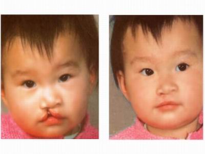 新生儿轻微兔唇是怎么造成的,怎么预防兔唇等缺陷