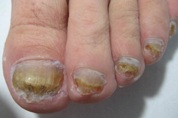 灰指甲一般是什么颜色,灰指甲是什么颜色才算是灰指甲