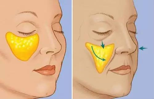 她们“肿”了，都是因为苹果肌惹的祸！