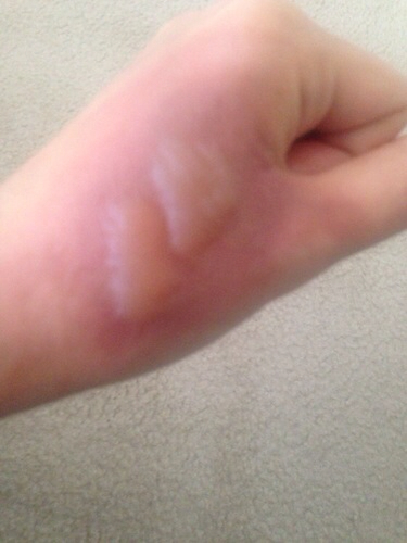 不谨慎被开水烫了能用冷水冲吗,不谨慎被开水烫到了怎么处理