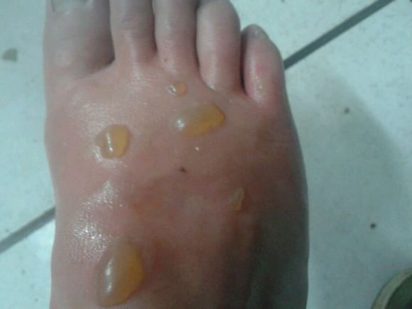 不谨慎被开水烫了能用冷水冲吗,不谨慎被开水烫到了怎么处理