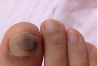 灰指甲一直修会好吗,灰指甲反反复复怎么办