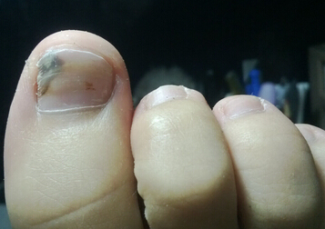 灰指甲一般是什么颜色,灰指甲是什么颜色才算是灰指甲