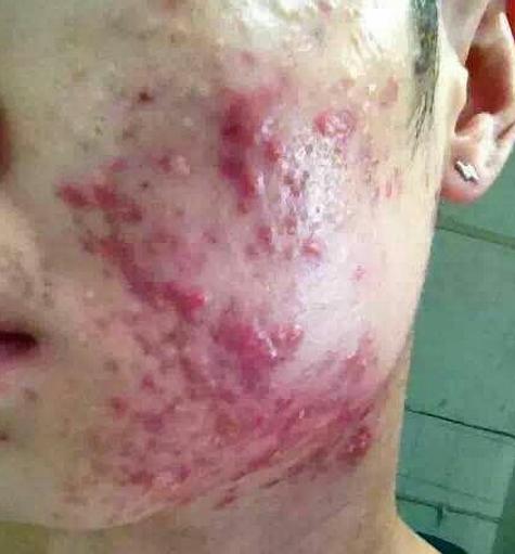 宝宝脸上痘痘有白色脓包,脸上长脓包痘痘怎么办