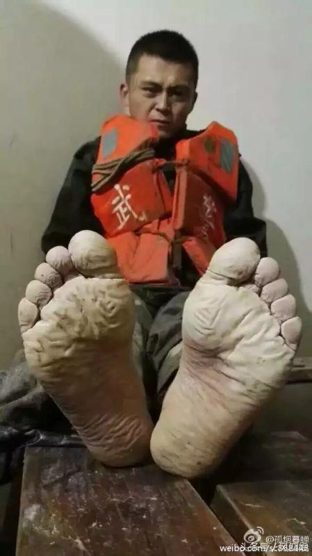 积水最佳治疗办法图片,积水如何彻底根治