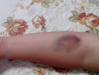 抽血导致皮下渗血怎么办,抽血后皮下淤血怎么处理