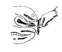 取环手术全过程（附图）