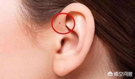 有些人耳朵有一个小洞,有的人耳朵上为什么有小洞洞