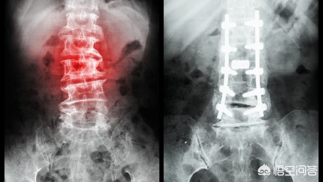 骨折保守治疗一定要手法复位吗,为什么有的骨折需要手术治疗