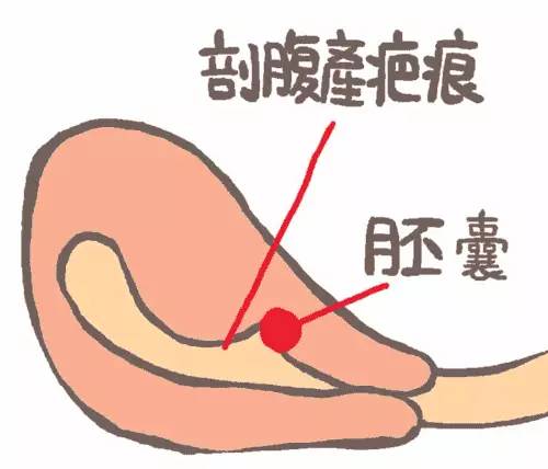 双胎有一个瘢痕妊娠怎么办,有妊娠纹二胎预防还有效吗