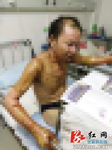 村民救山火被炸伤谁担责,被火药烧伤的张家界